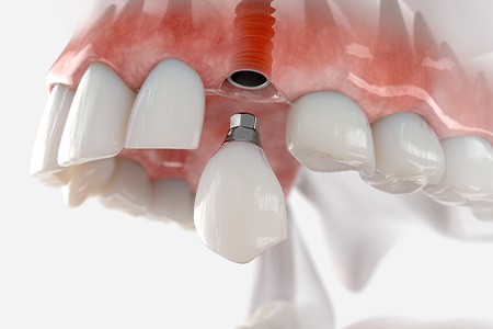 Single dental implant in mouth mold 