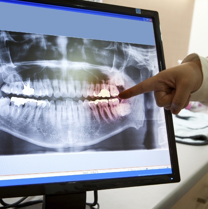 Dentist pointing to teeth on a dental x ray