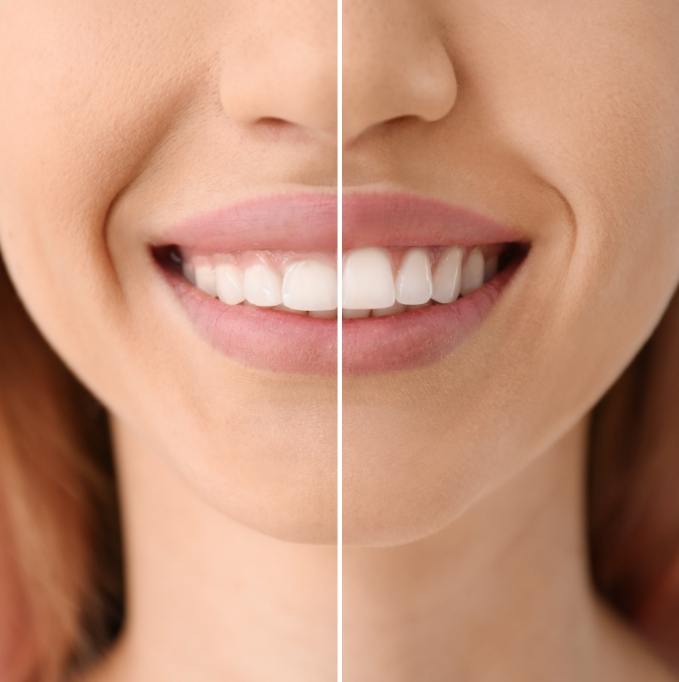 Before and after gum recontouring treatment