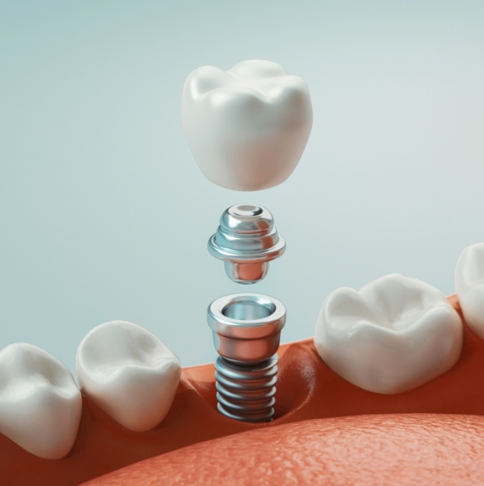 Dental crown abutment and dental implant post being inserted into jaw