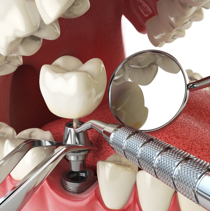 Illustration of a dental implant post being placed