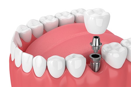 Illustration of crown being attached to dental implant in lower arch