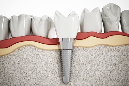 Illustration of dental implant in jawbone