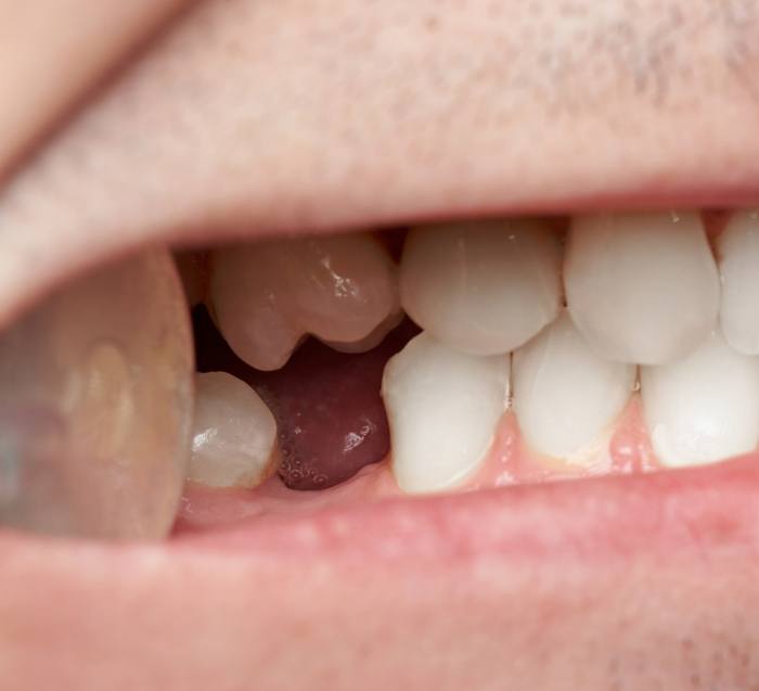 Close up of a missing tooth in San Jose