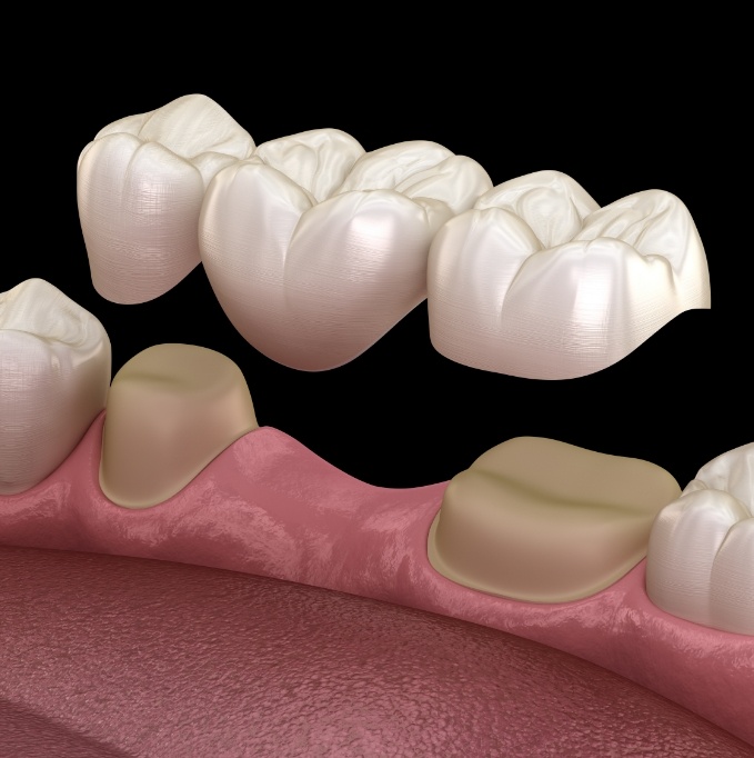 Illustration of dental bridge for replacing missing teeth in San Jose