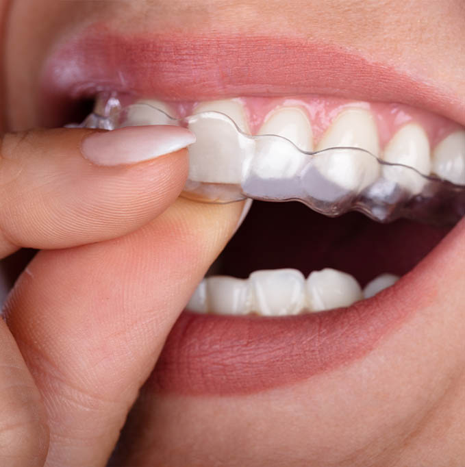 Close up of putting in a clear aligner