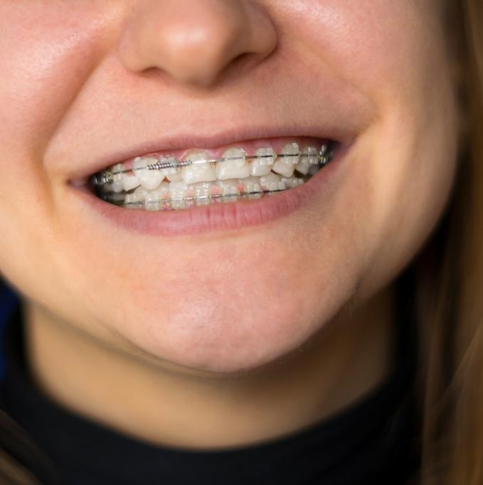 Braces with see-through brackets