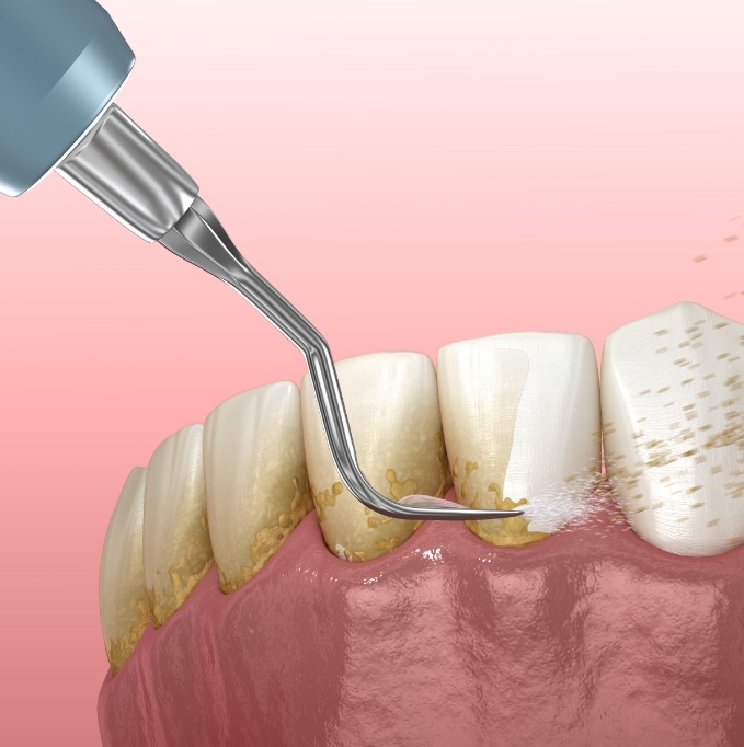 Illustration of scaling and root planing for gum disease treatment