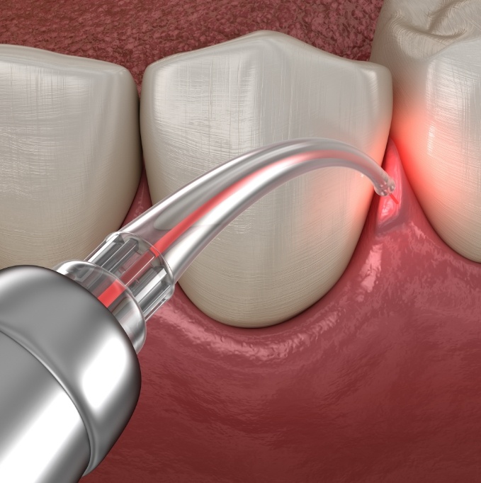 Illustration of gums being treated with laser