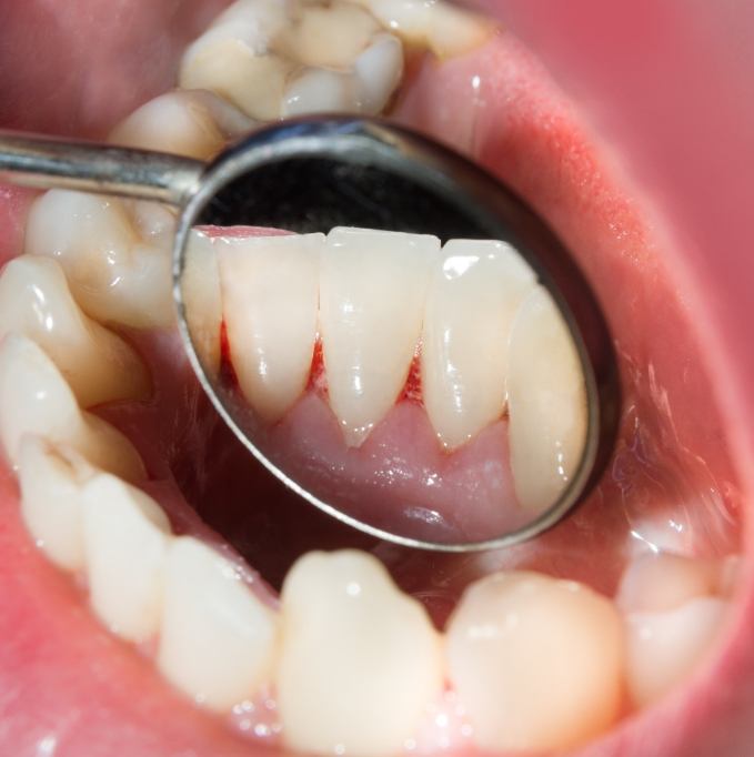 Examining diseased gums with dental mirror