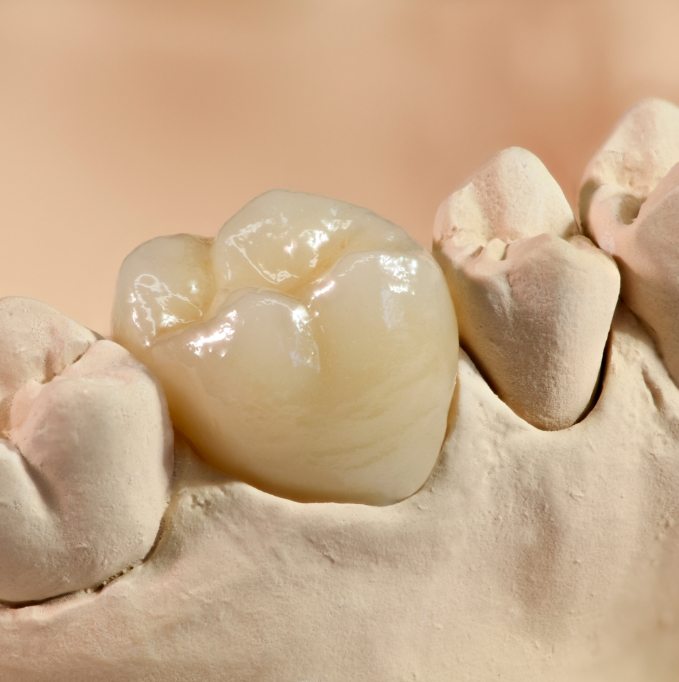 Dental crown in a model of the jawbone