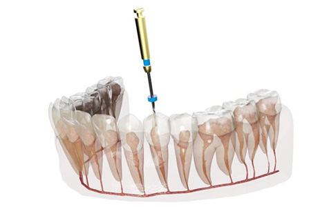 Digital image of a root canal 