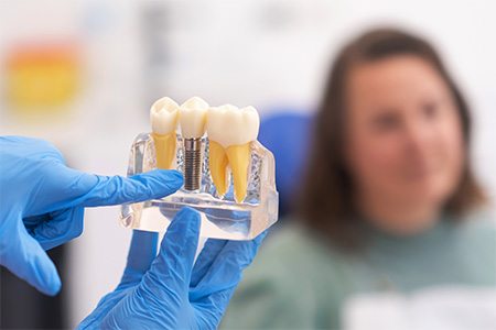 Showing a patient a model of a dental implant