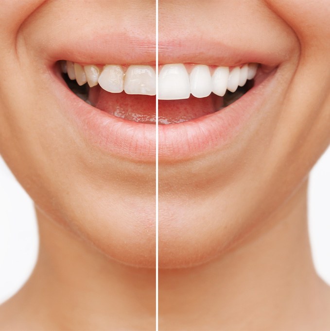 Woman before and after veneers